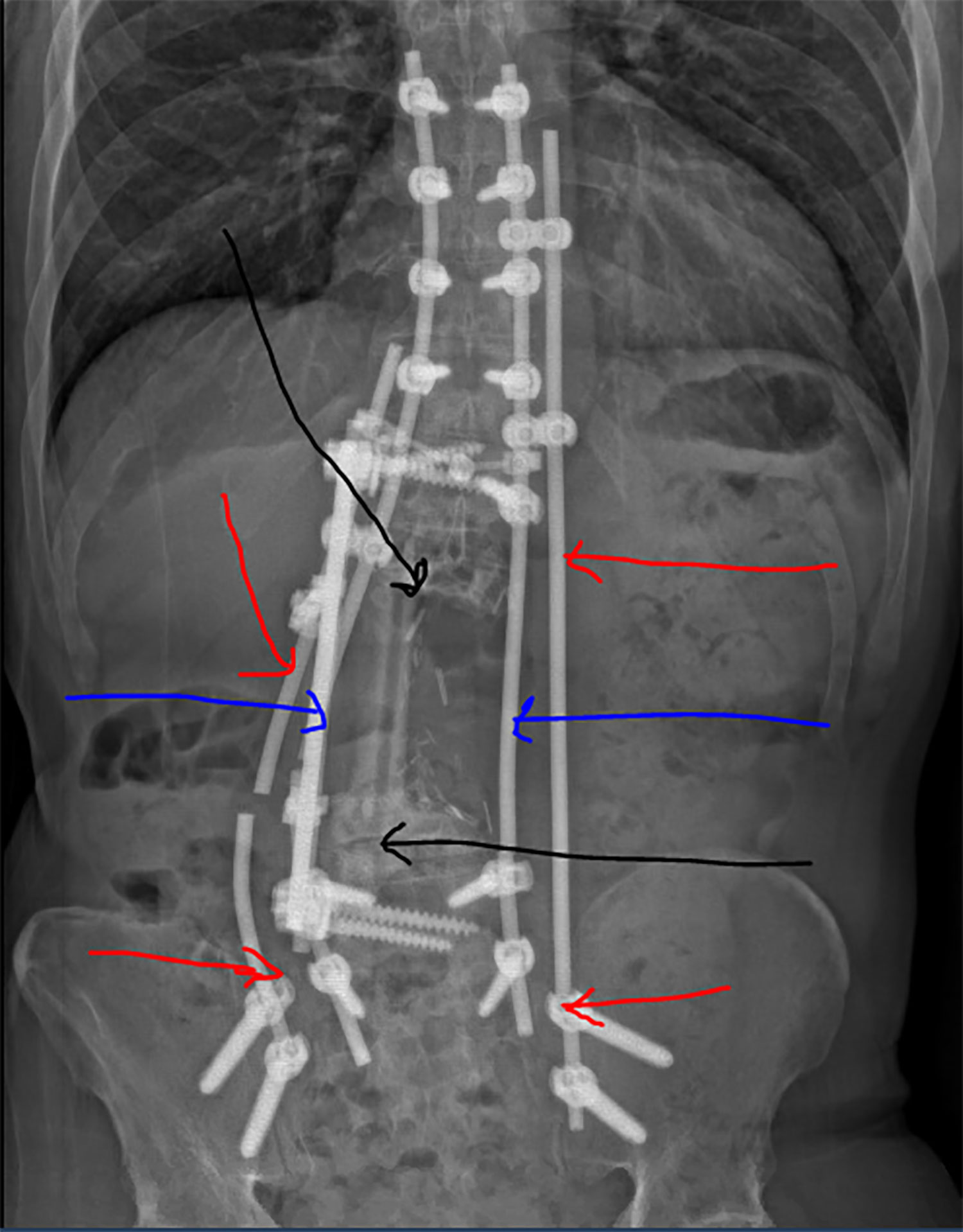 Todd Balf's spine cancer X-ray